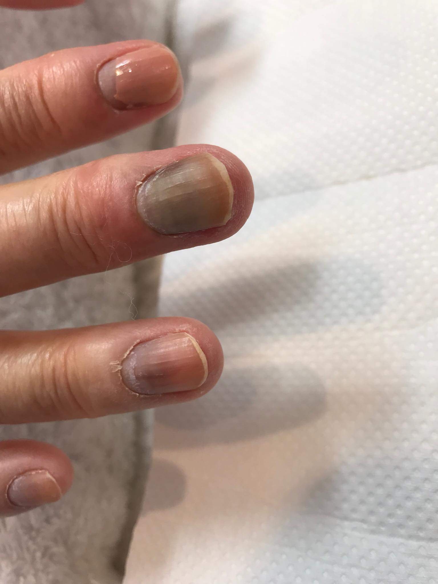 抗がん剤の副作用 爪への影響について Npo法人 全国福祉理美容師養成協会